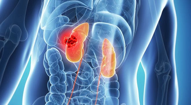 Distress Levels High Among Patients With Common Form of Kidney Cancer