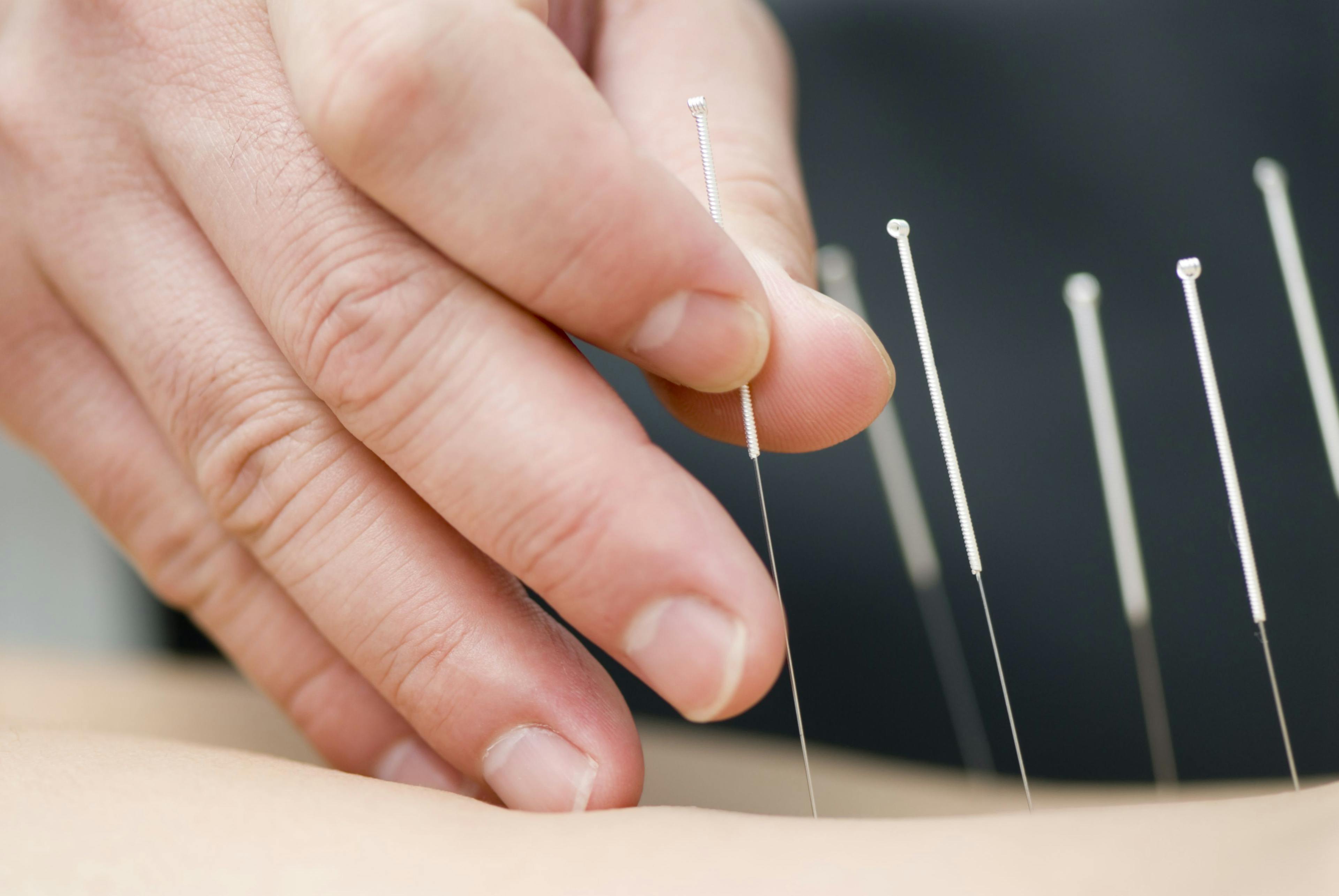 Acupuncture May Reduce Chronic Pain in Cancer Survivors