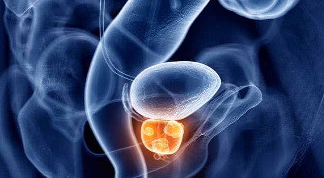 Relumina Appears Superior to Hormone Associated Therapy Leuprolide for Patients with Advanced Prostate Cancer