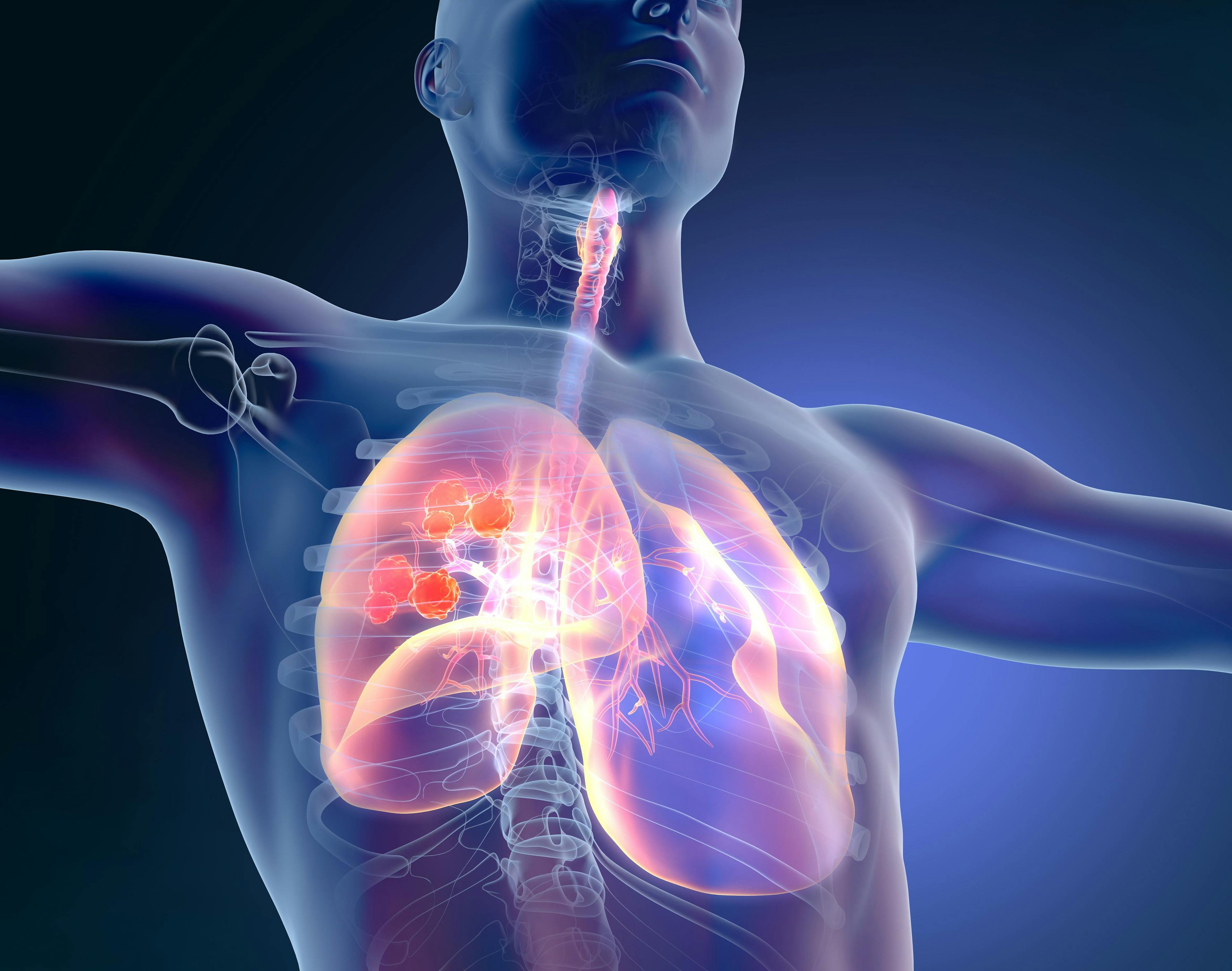 7 Recent News and Updates in Lung Cancer