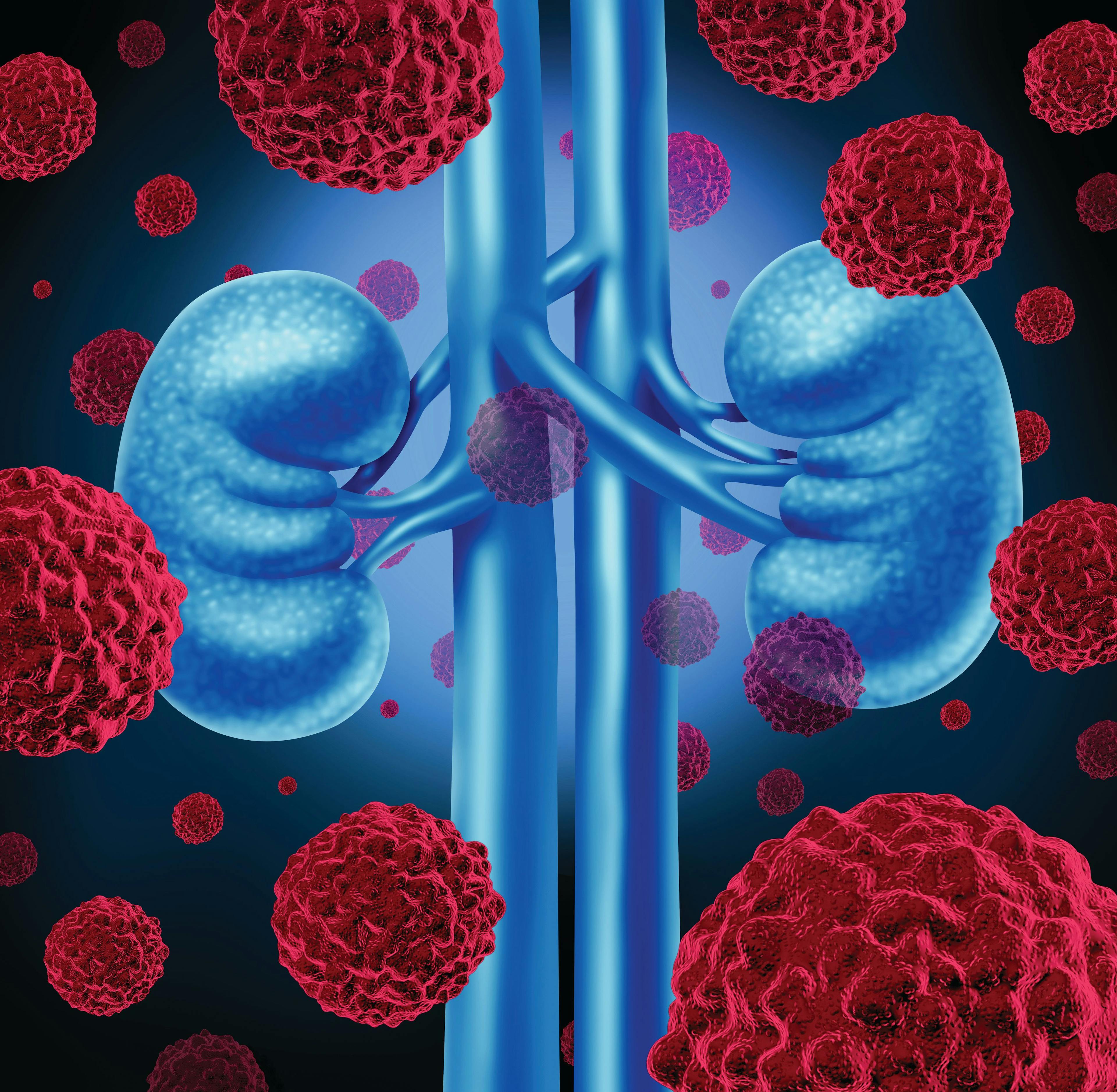 Fotivda Nearly Doubles Duration of Response Compared With Nexavar in Metastatic Kidney Cancer