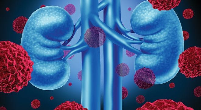 Tolerability of Fotivda Is Key in Treating Relapsed, Refractory Renal Cell Carcinoma