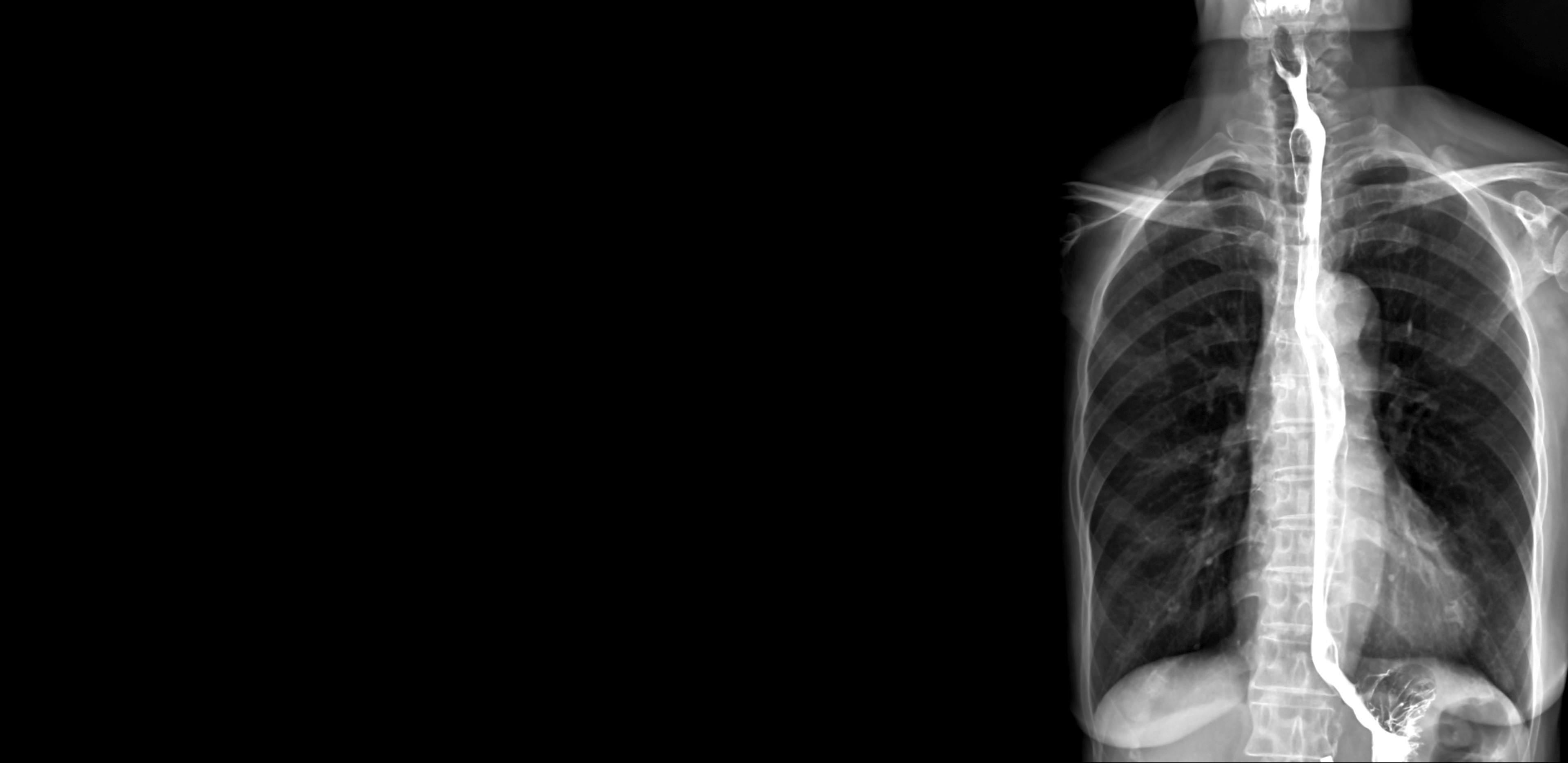 Esophagram or Barium swallow AP view is an X-ray of the esophagus ,The patient drinks a liquid that contains barium .The liquid coats the esophagus and X-rays are taken for finding cancer | Image credit: - © samunella - © stock.adobe.com