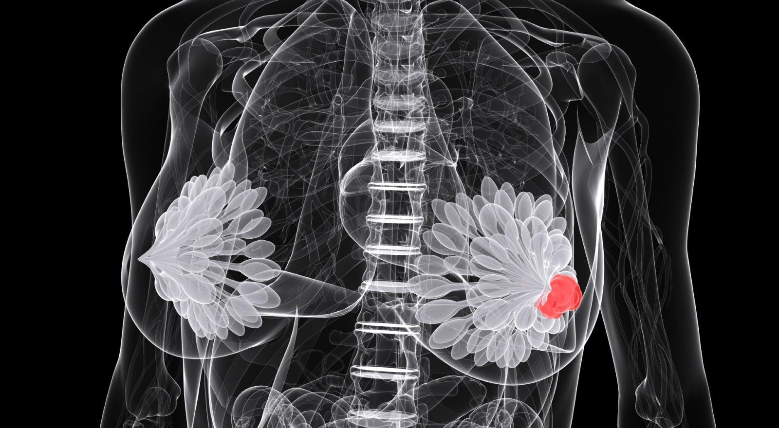FDA Lifts Hold on Trial Investigating Novel Drug in Patients With High-Risk Breast Cancer