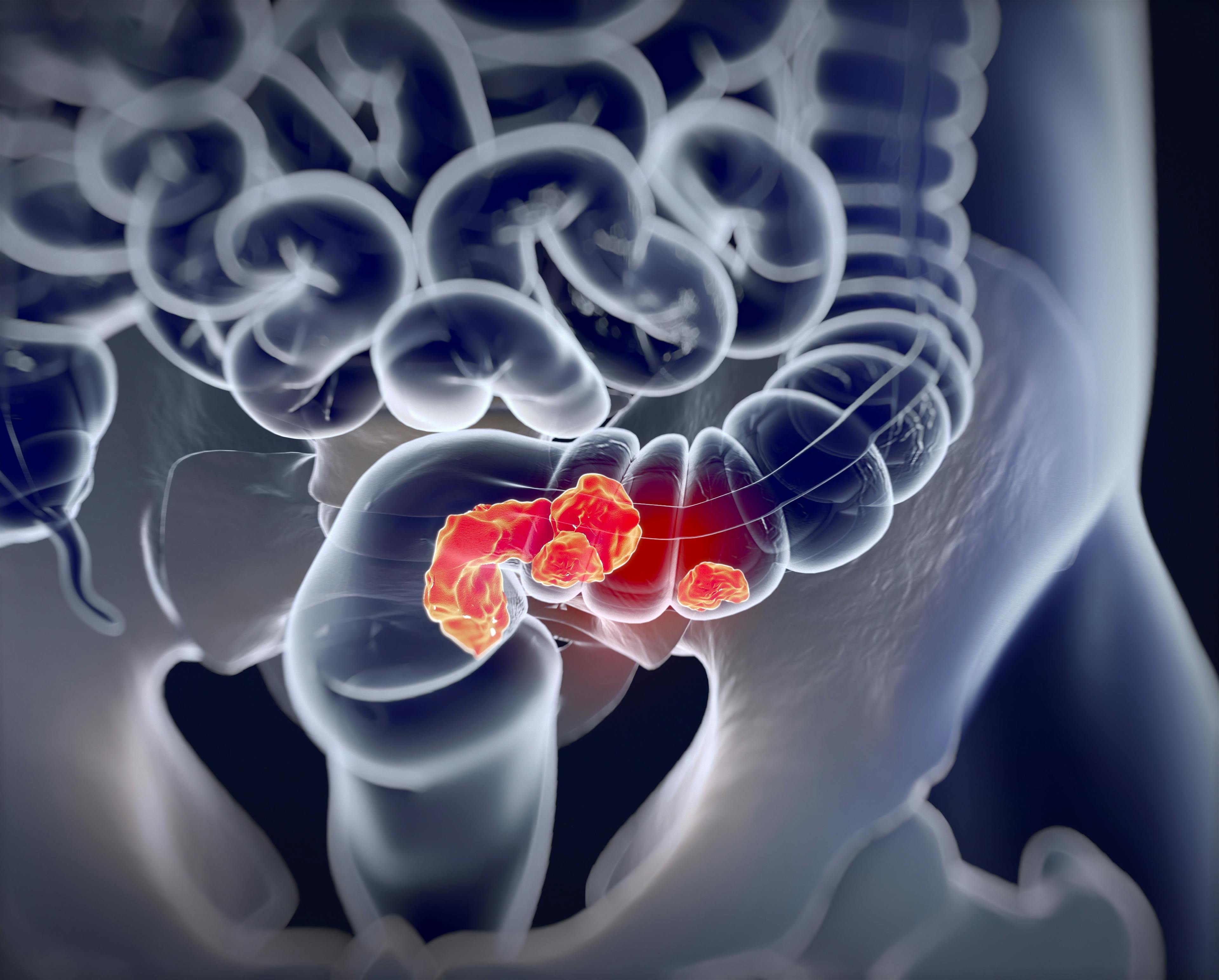 Recent Colon Cancer News and Updates Patients and Survivors May Have Missed